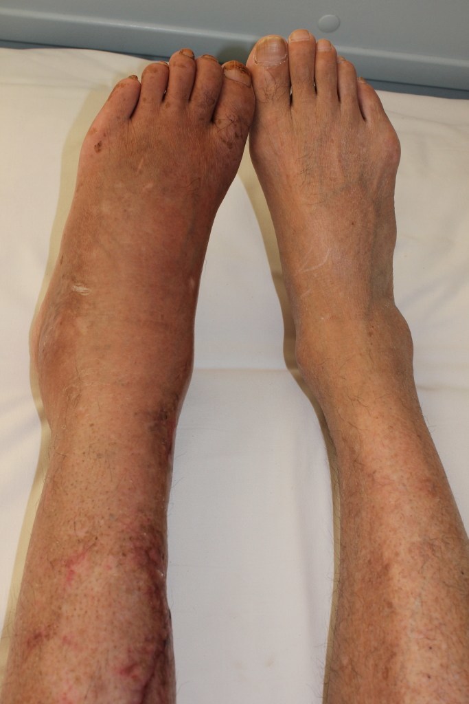 Complex Regional Pain Syndrome Type 2 Of Right Lower Extremity