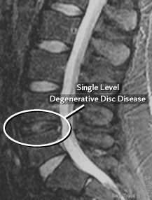 Degenerative Disc Disease 