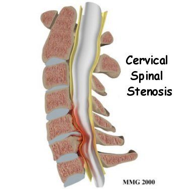Spinal Stenosis Diagram