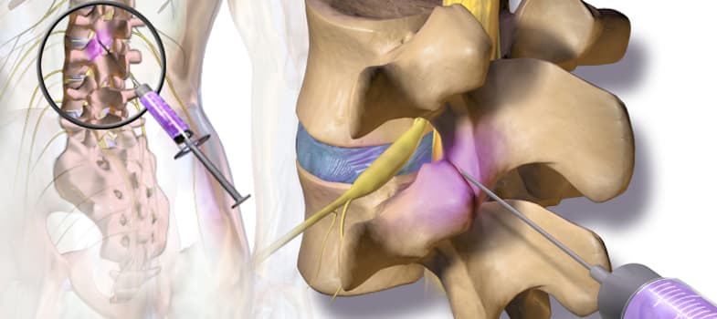 Facet Joint Syndrome Treatments